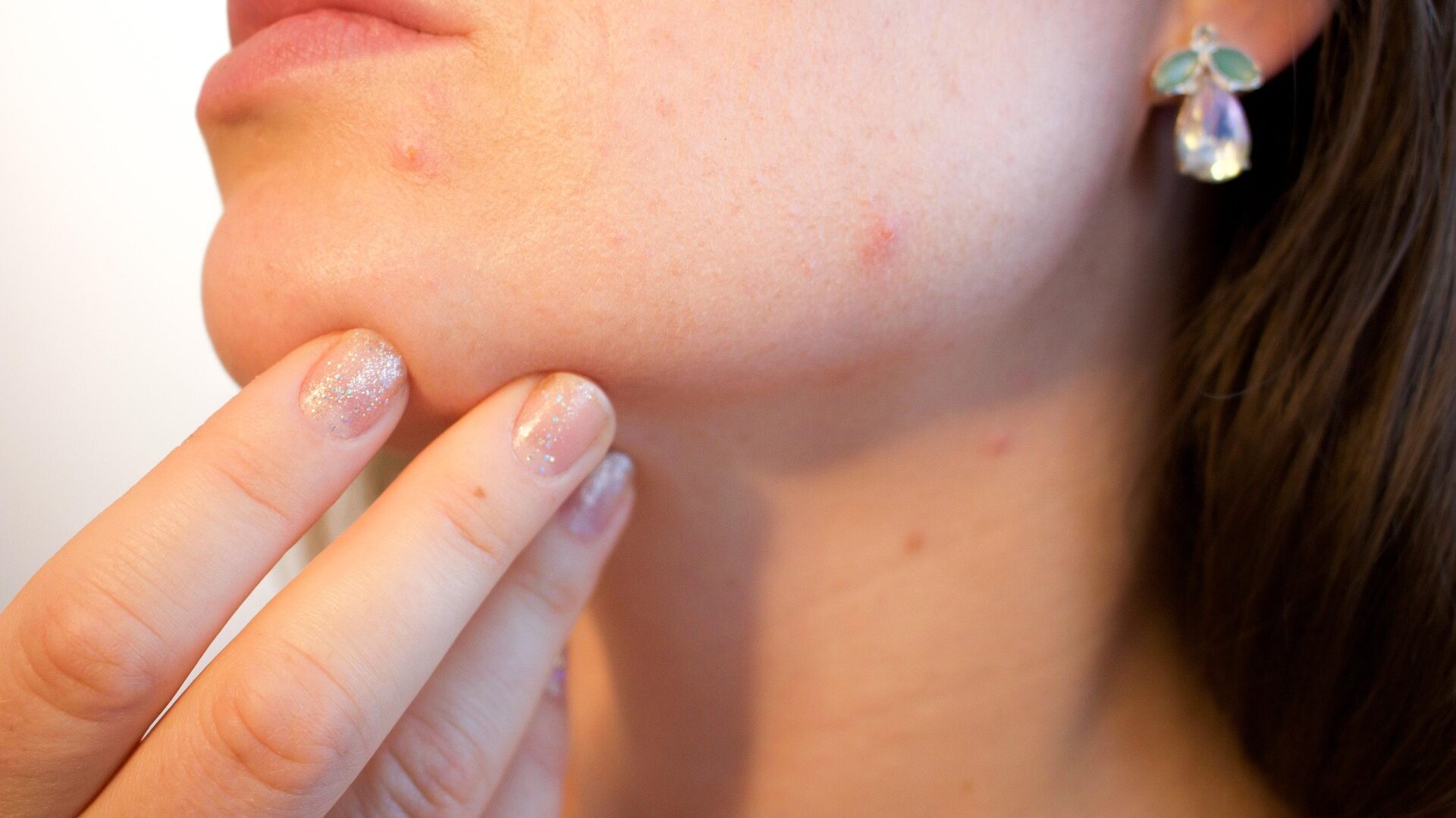Dr. Pimple Popper: Alles über Dr. Sandra Lee, ihre Serien und spektakuläre Hautfälle 2 Dr. Pimple Popper hat viele Patient:innen mit Akne.